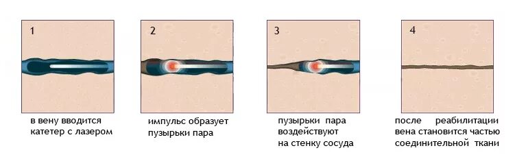 Эндовазальная лазерная коагуляция варикозных вен. ЭВЛК лазерная коагуляция варикозных вен. Лазерная облитерация (коагуляция) вен.