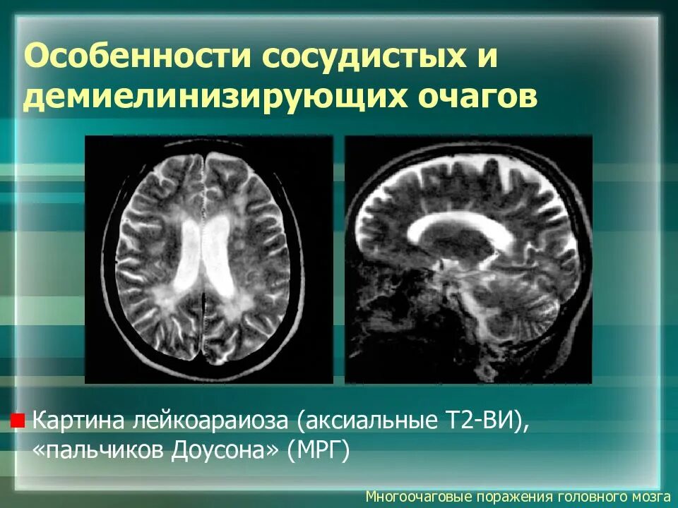 Признаки демиелинизирующего поражения. Рассеянный склероз демиелинизация. Демиелинизирующие очаги. Очаги демиелинизации на мрт. Очаги демиелинизации головного мозга что это такое.