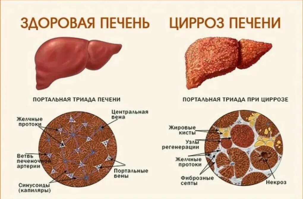 Клетки печени разрушаются. Патогенетическая терапия цирроза печени. Заболевания печени цирроз печени. Предпосылки цирроза печени. Причины заболевания цирроза печени.