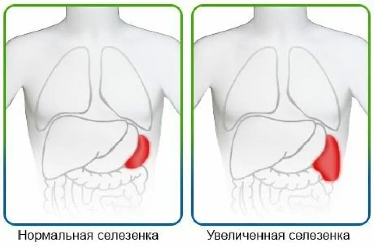 Увеличение размеров печени и селезенки. Увеличенная печень и селезенка. Расширенная селезенка