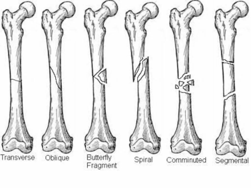Врожденные и приобретенные переломы. Врожденные переломы костей. Внутриутробные переломы костей скелета. Переломы костей человека в картинках.