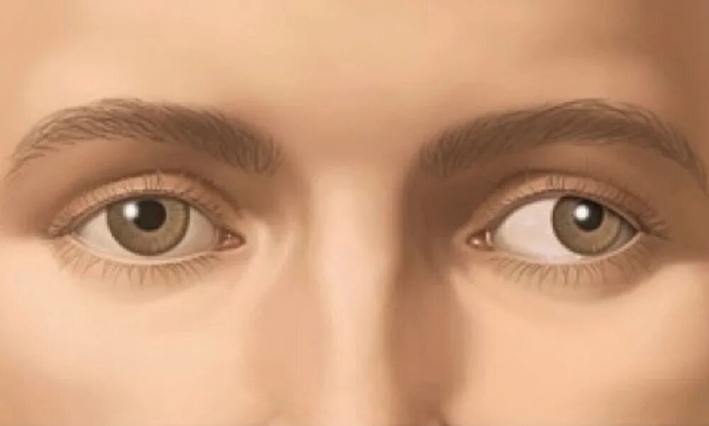 Глазами переехавших. Амблиопия (синдром ленивого глаза). Косоглазие и амблиопия. Глаза в разыеке стороны. Глазы в разные стороны.