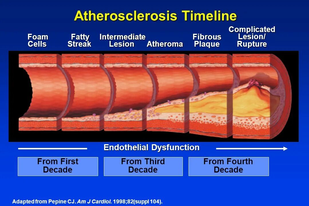 Артерий атеросклероз латынь. Атеросклероз аорты и сосудов. Повреждение сосудистой стенки атеросклероз.