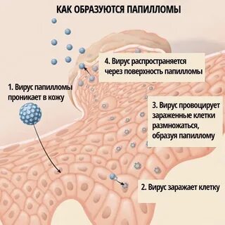 От папиломо вирусной инфекции