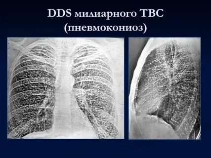 Пневмокониоз
