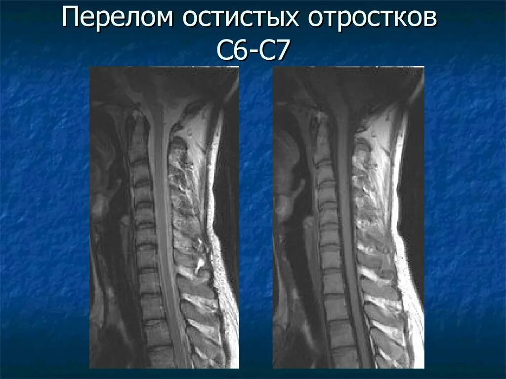 Отдел разрыв. Перелом остистого отростка с6 с7 позвонка. Перелом остистого отростка l5 рентген. Травма спинного мозга с6 с7 операция. Перелом остистых отростков шейных позвонков рентген.