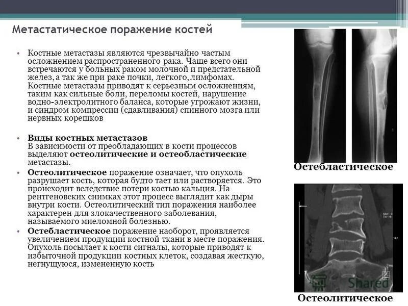 Вторичное поражение костей. Остеобластические метастазы рентген. Остеобластические метастазы в кости на кт. Остеобластические метастазы в костях рентген. Рентгенодиагностика метастатического поражения костей.