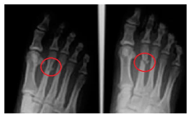 Перелом кости стопы сколько заживает у взрослых. Перелом 2 плюсневой кости кости. Маршевый перелом 2 плюсневой кости. Субкапитальный перелом 5 плюсневой кости. Рентген перелом 2 плюсневой кости стопы.