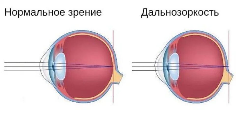 Недостатки дальнозоркости. Строение глаза дальнозоркость. Зрение дальнозоркость. Заболевания глаз близорукость и дальнозоркость. Рисунок глаза при дальнозоркости.