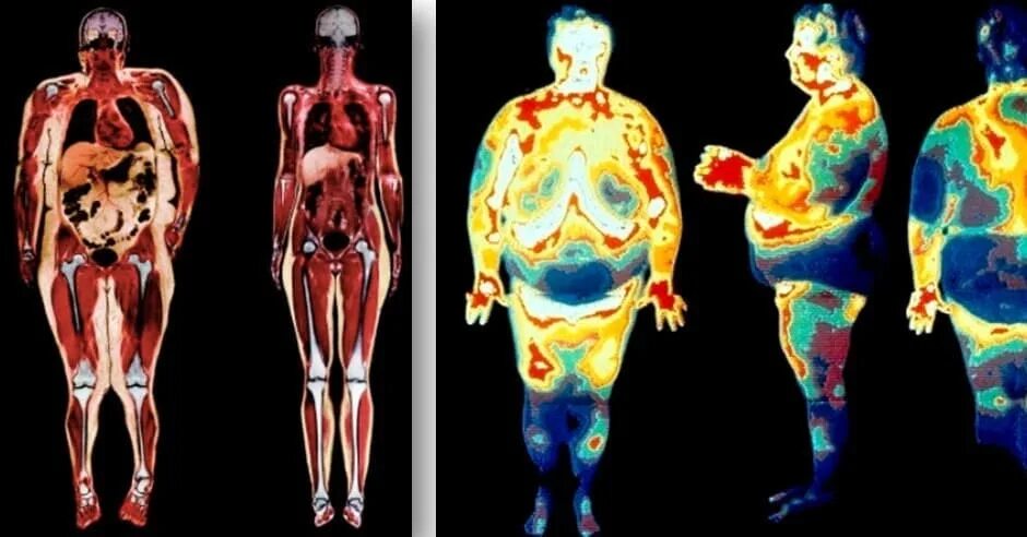хроническое воспаление жировой ткани. жировая ткань при ожирении. подкожный жир и висцеральный жир. воспаление жировой ткани. жировая ткань при ожирении.