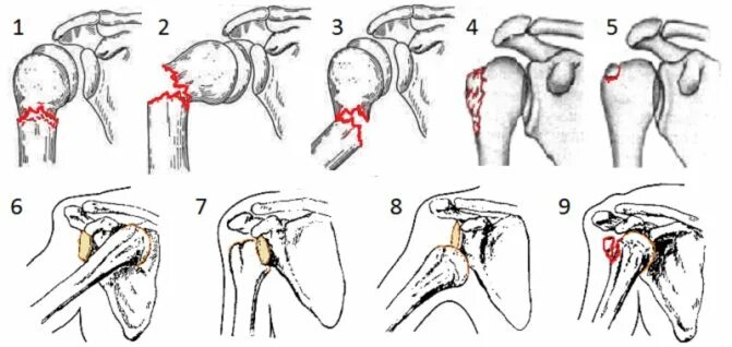 Вывих плеча и перелом хирургической шейки. Вывих с переломом головки и шейки плеча. Перелом хирургической шейки плечевой кости вывих плечевого сустава. Перелом головки плечевой кости при вывихе. После операции болят плечи