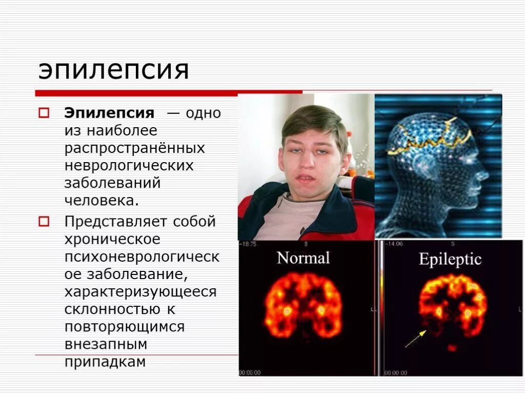 Эпилепсия презентация. Презентация на тему эпилепсия.