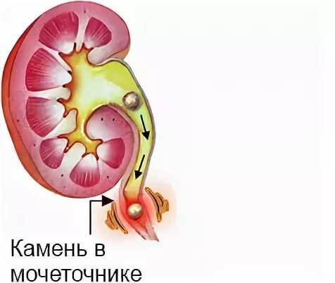 Двусторонняя пиелоэктазия почек. Что такое лоханка у ребенка в утробе. Расширение в почке у новорожденного. Пиелоэктазия код по мкб у детей