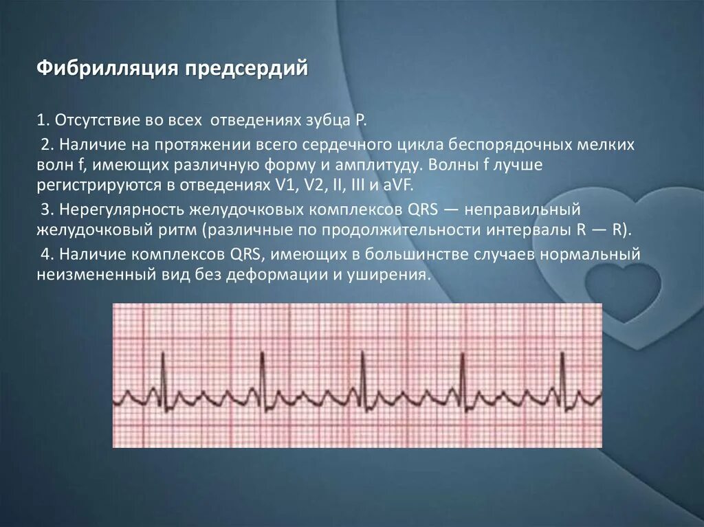 Фибрилляция форум. Фибрилляция предсердий экг 2 отведение. сердечный ритм при фибрилляции предсердий. персистирующая фибрилляция предсердий экг. пароксизм фибрилляции предсердий на экг.