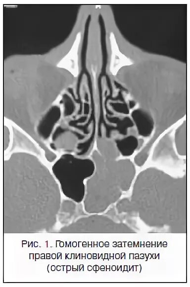 Сфеноидит на кт. Клиновидная пазуха на кт. Клиновидная пазуха рентген.