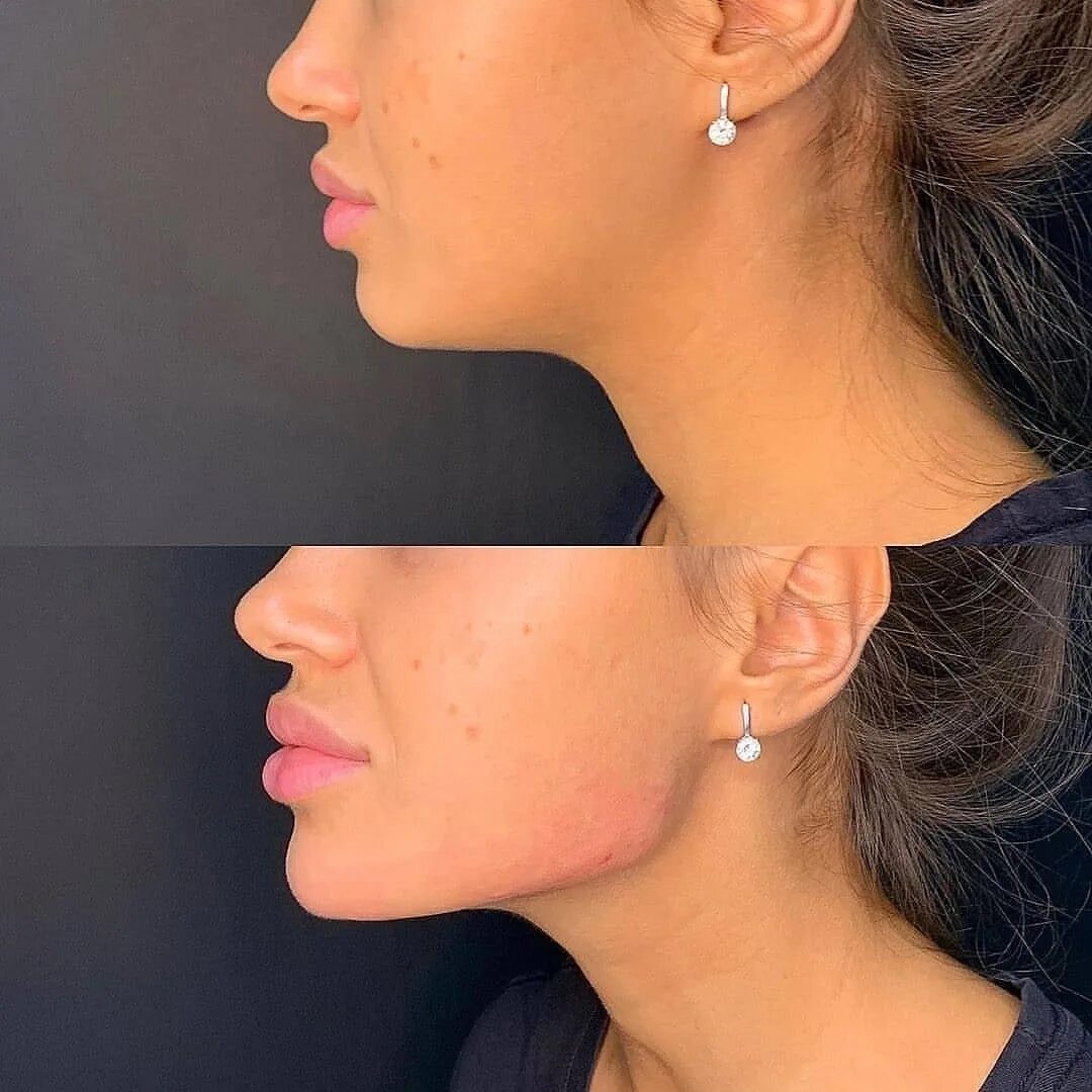 контурная пластика челюсти