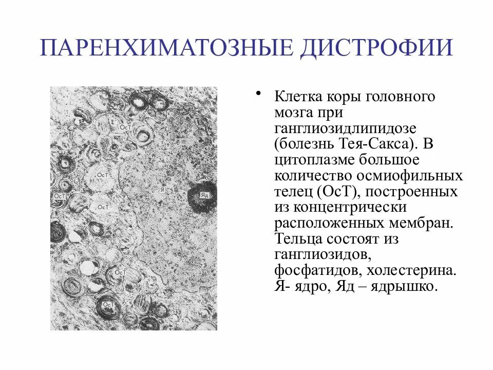 Жировые паренхиматозные дистрофии это микроскопия. Паренхиматозная дистрофия микроскопия. Жировая дистрофия истощение микроскопия. Паренхиматозные жировые дистрофии микроскоп.