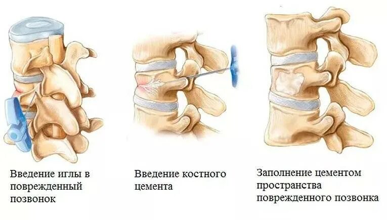 Операция на позвоночнике отзывы пациентов. Чрескожная вертебропластика позвонка что это. Вертебропластика l2 позвонка. Компрессионный перелом вертебропластика. Пункционная вертебропластика позвоночника.