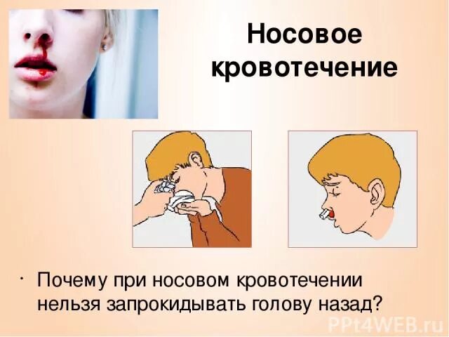 Тесты ответы носовые кровотечения. Запрокидывать голову при носовом кровотечении. При кровотечении из носа.