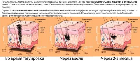 Косметическое удаление верхнего слоя кожи