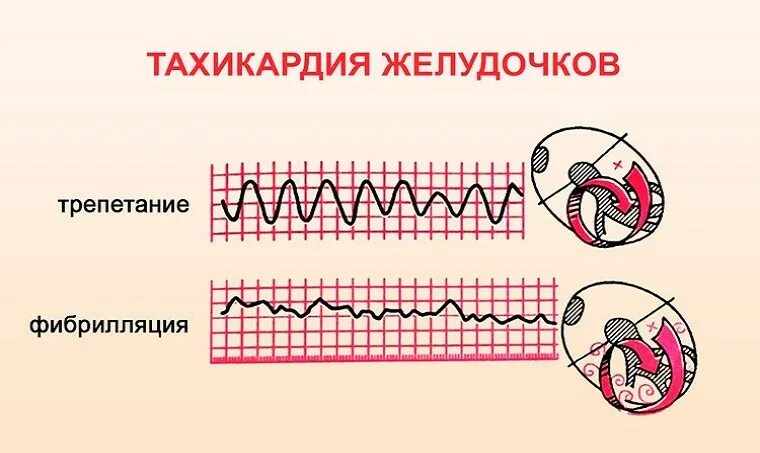 Синусовая тахикардия причины. Купирование приступа наджелудочковой тахикардии. Лекарства при аритмии и тахикардии. Что можно при тахикардии. Народные средства от сердцебиения.