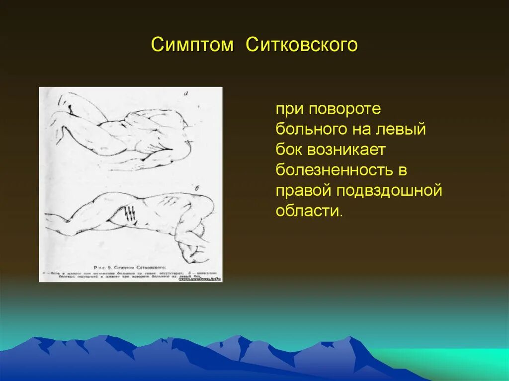 Аппендицит щеткин блюмберг. Симптом Ситковского острого аппендицита. Симптомы Ровзинга Ситковского Бартомье-Михельсона. Щеткина—Блюмберга, Ситковского, Ровзинга, Воскресенского, Образцова. Симптомы Щеткина -Блюмберга Ситковского Ровзинга.