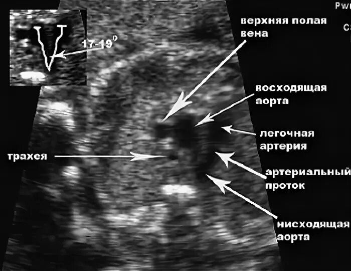 Общий артериальный ствол ЭХОКГ. Боталлов проток на ЭХОКГ. Персистирующая верхняя полая Вена УЗИ. Транспозиция магистральных сосудов ЭХОКГ.