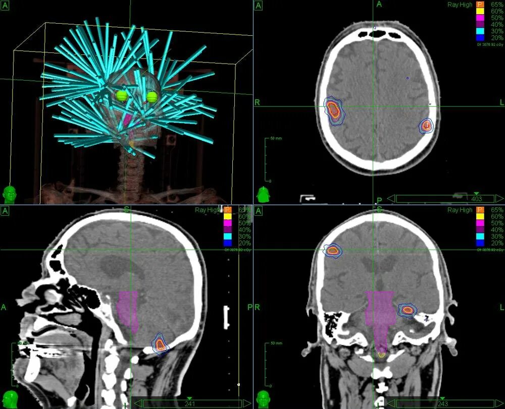 Лечение метастазов мозга. Метастатические опухоли головного мозга. Опухоль головного мозга метастазы. Метастазы головного мозга кт.