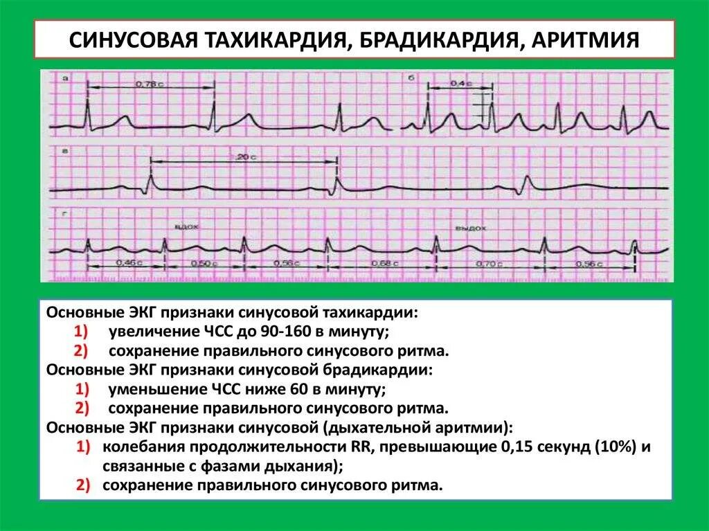 Брадикардия синусовая аритмия ЭКГ. Нарушение сердечного ритма синусовая тахикардия. Брадикардия на ЭКГ при аритмии. Синусовая брадикардия на ЭКГ.