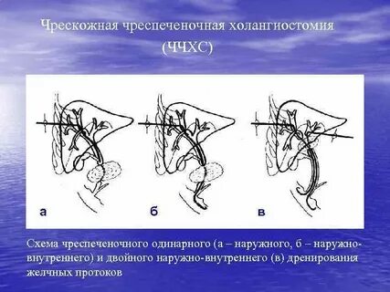 Проток операция