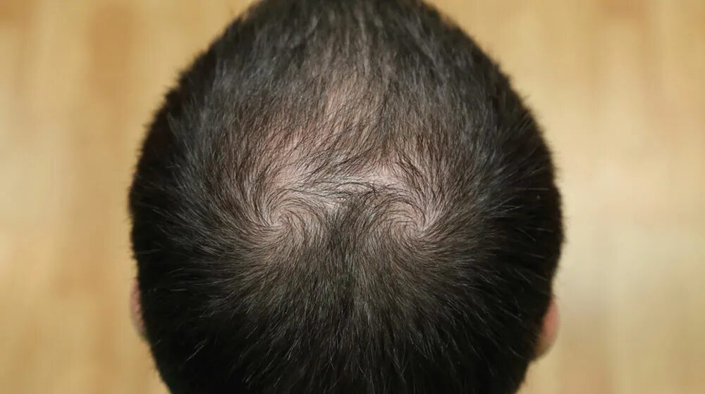 Алопеция передается по наследству. Сонник облысение. Сонник облысение. Перхоти волос у мужчин. Прически для мужчин с облысением.