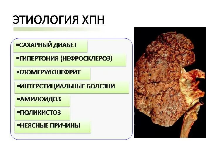 Хпн у людей. Хроническая почечная недостаточность патанатомия. стадии хронической почечной недостаточности патанатомия. вид почек при хронической почечной недостаточности. хроническая почечная недостаточность (хпн).