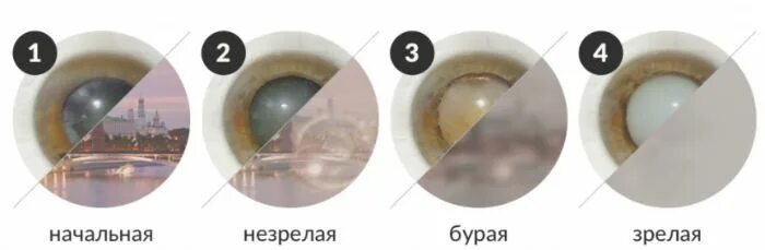 Стадии развития катаракты. Катаракта начальная стадия. 1 признаки катаракты