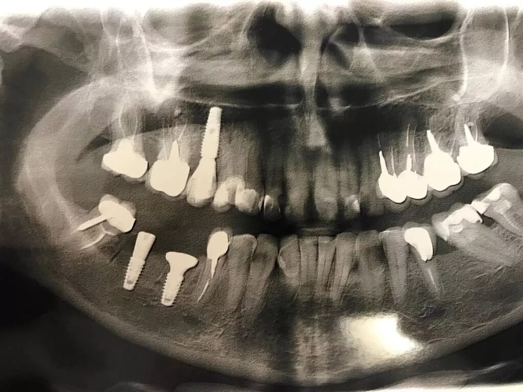 Снимки с имплантами зубов. Снимок зубов с имплантами. Имплант 4.6 зуба рентген.