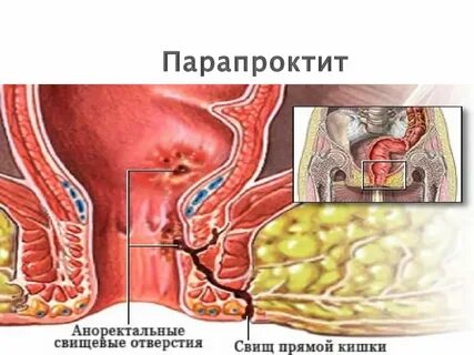 Острый парапроктит операции