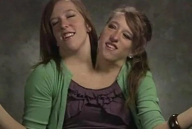 Близнецы с двумя головами. Близнецы с двумя головами. Сестры эбби и бриттани. Британи хенсел сиамские близнецы. Эбигейл и британи хенсел.