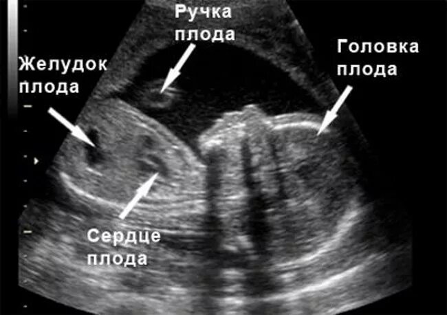 Ребенок на 20 неделе беременности узи. УЗИ плода на 20 неделе беременности. УЗИ сердца плода 20 недель. Малыш на 20 неделе беременности УЗИ. Снимок УЗИ беременности 20 недель.