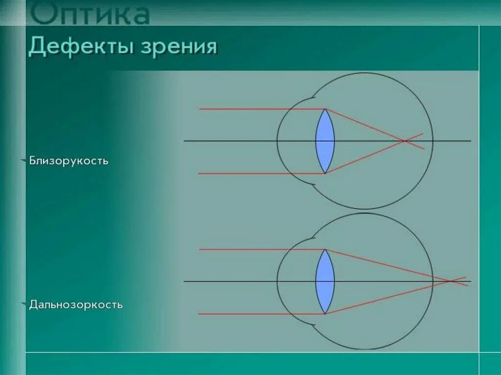 Как можно скорректировать зрение при помощи линз. Линзы и дефекты зрения. Дефекты зрения дальнозоркость. Выпуклые линзы для близоруких. Рассеивающая линза для близорукости.