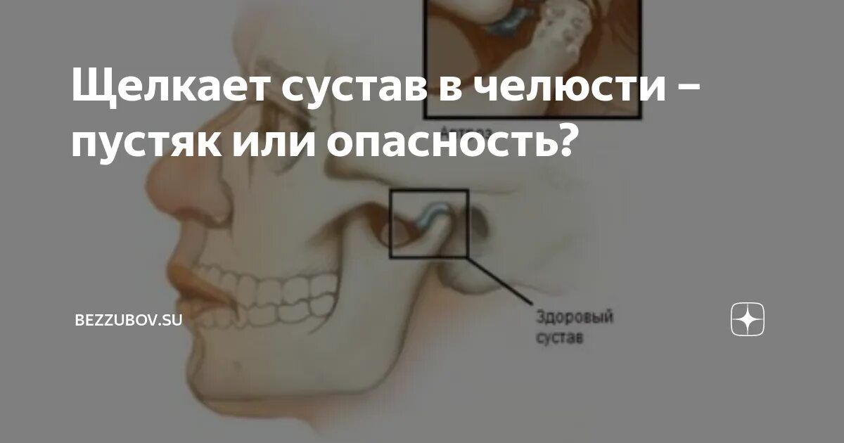 Щелкает челюсть при открытии рта что делать. Щелкает сустав в челюсти. Щелкает правая сторона челюсти. Щёлкает челюсть при жевании.