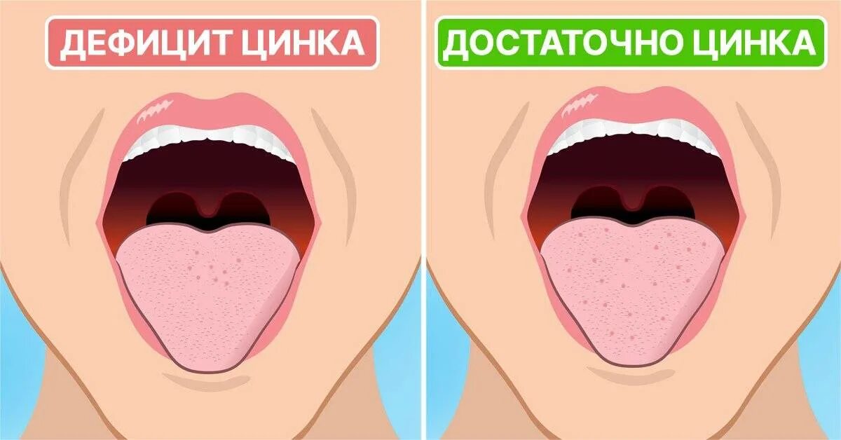 Кислота во рту после еды лечение. Неприятный вкус привкус во рту. Привкус кислоты во рту.