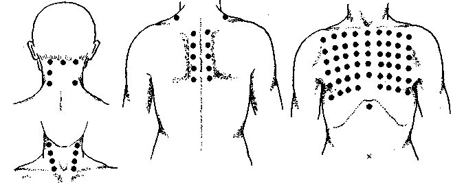 массаж при астме. массаж при астме. массаж при астме. активные точки при бронхиальной астме. изменение бронхов при бронхиальной астме.