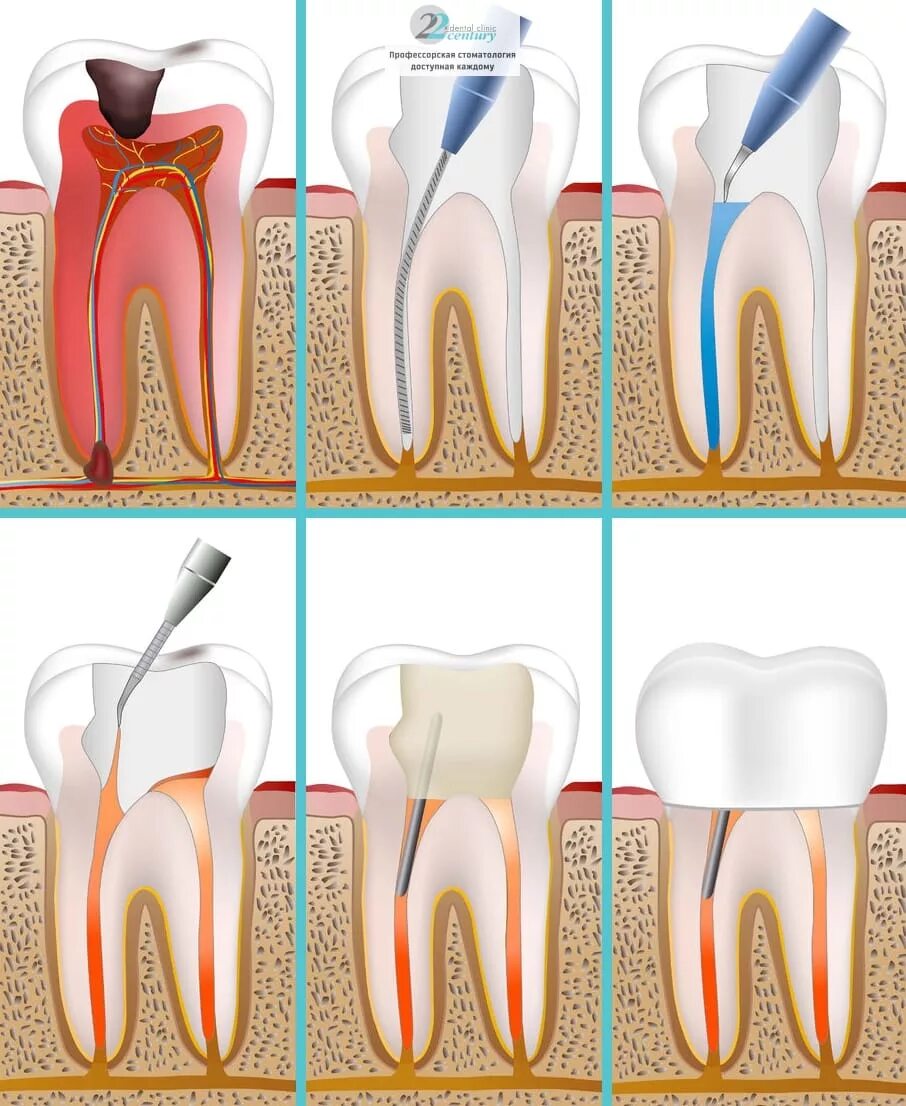 Расширение каналов зубов. Хронический периодонтит. Апикальный периодонтит.