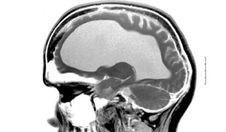 Диета при гидроцефалии мозга. Гидроцефалия головного мозга. Гидроцефалия стекловидное тело. Гидроцефалия головного мозга мрт. Наружная гидроцефалия мрт.