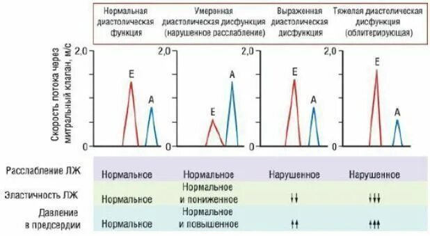 Диастолическая дисфункция лж 2 степени. Типы диастолической дисфункции левого желудочка. Диастолическая дисфункция лж 1 типа. Псевдонормальный Тип диастолической дисфункции левого желудочка.