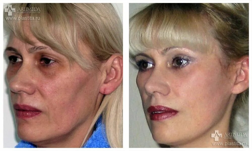 аденоидное лицо до и после. лицо с аденоидный тип лица. аденоидный тип лица у детей. аденоидное лицо до и после. аденоидное лицо до и после.