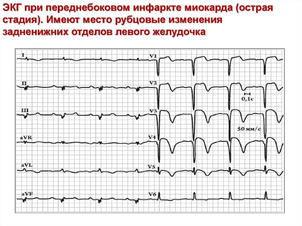 Умеренные диффузные изменения экг. Экг инфаркт миокарда, рубцовые изменения. Изменения миокарда на экг при беременности. Изменения миокарда передне-перегородочной области на экг. Отклонение миокарда.