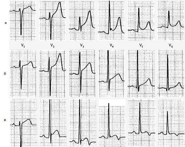 Экг подъем. Инфаркт миокарда с подъемом сегмента St ЭКГ. Подъем сегмента St на ЭКГ при инфаркте. ЭКГ острый инфаркт миокарда с подъемом сегмента. ЭКГ инфаркт миокарда без подъема St.