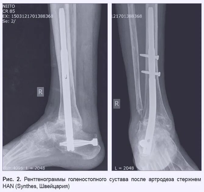 После артродеза голеностопного сустава. Артродез голеностопного сустава. Голеностопный сустав рентген норма. Артродез голеностопного сустава рентген. Внутрисуставной артродез.