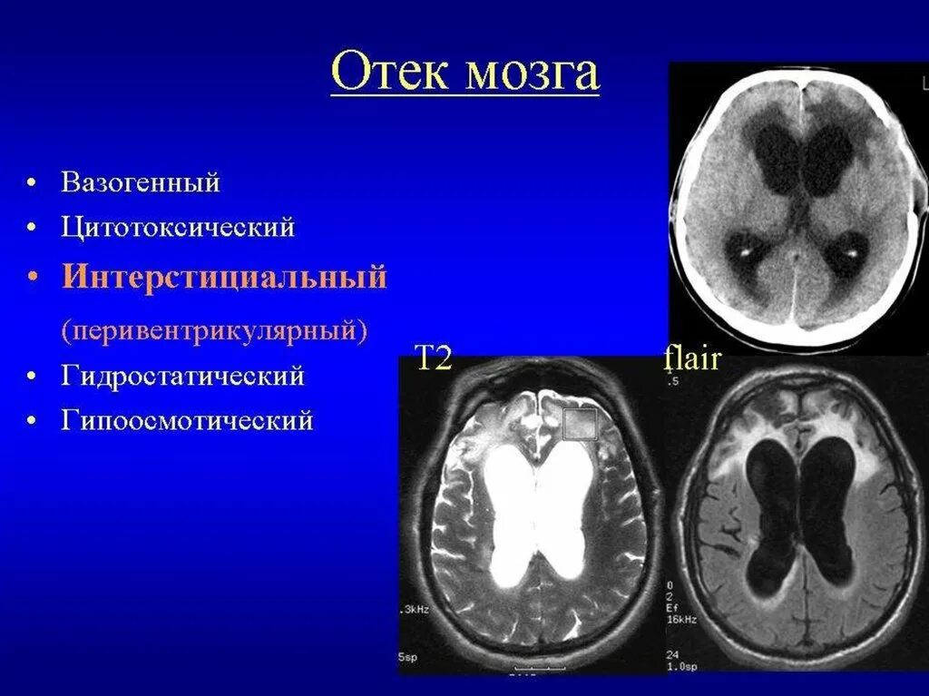 Оттек головного мозга