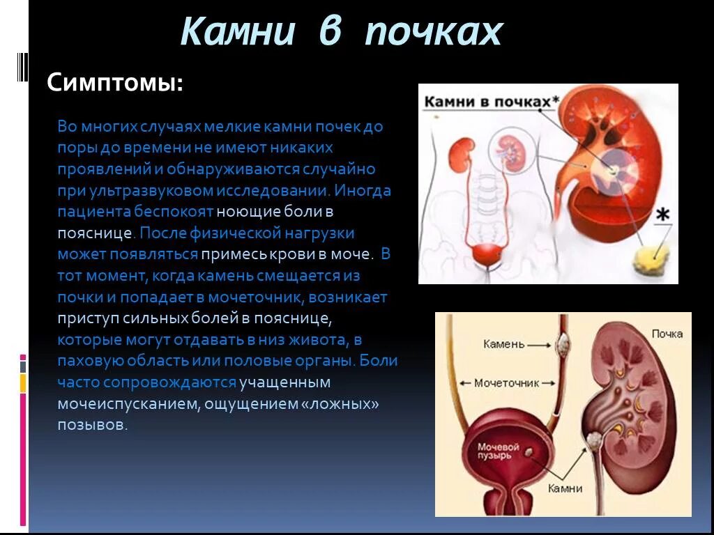 Почки дают температуру. Камни в посках симптом.